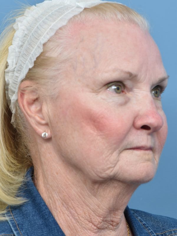 Neck Lift Before & After