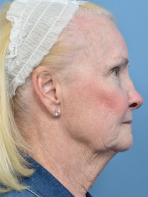 Neck Lift Before & After