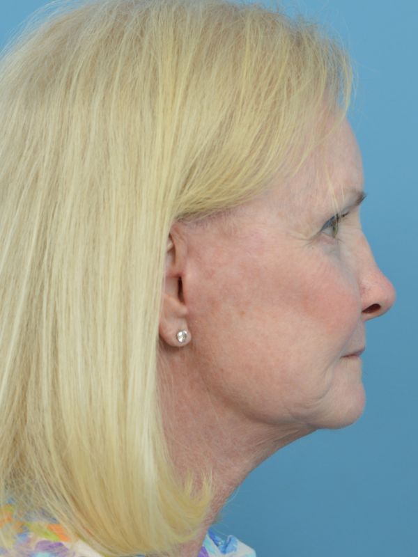 Neck Lift Before & After