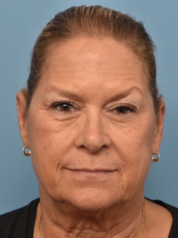 Neck Lift Before & After