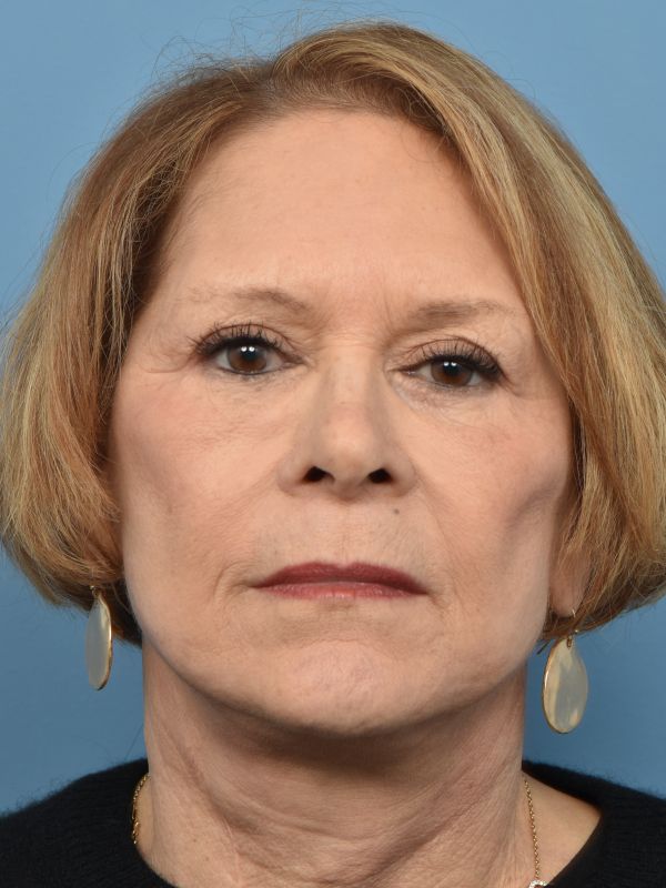 Neck Lift Before & After