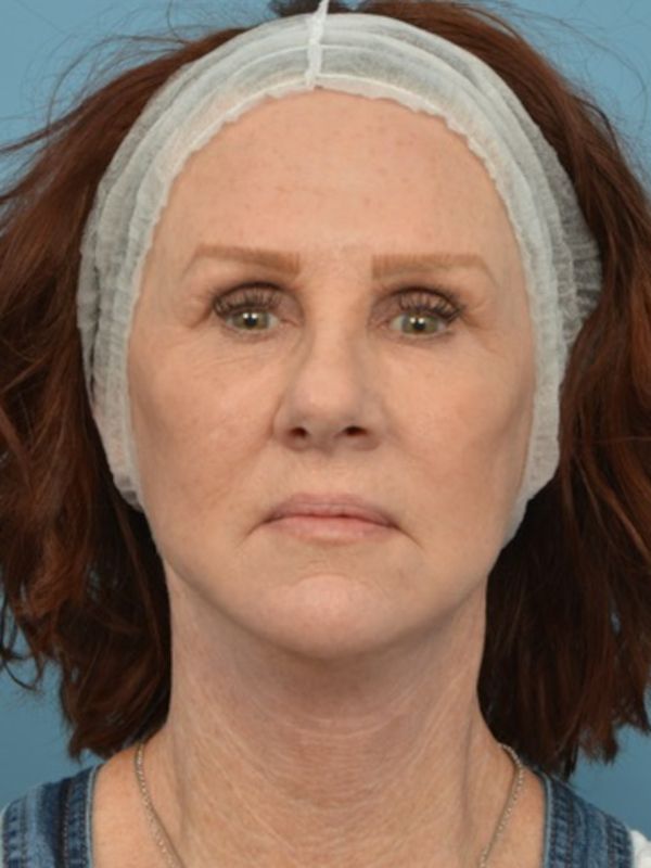 Neck Lift Before & After