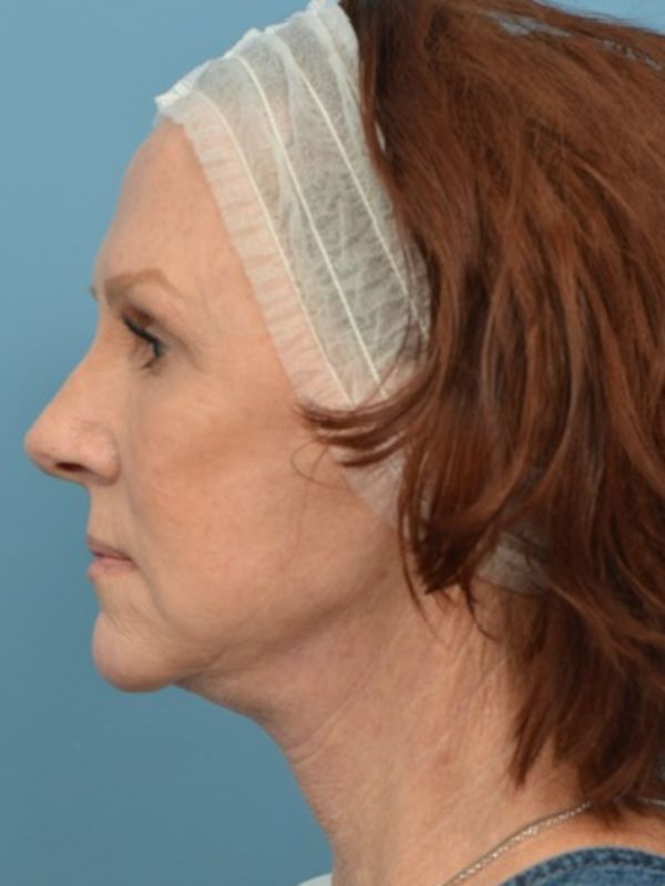 Neck Lift Before & After
