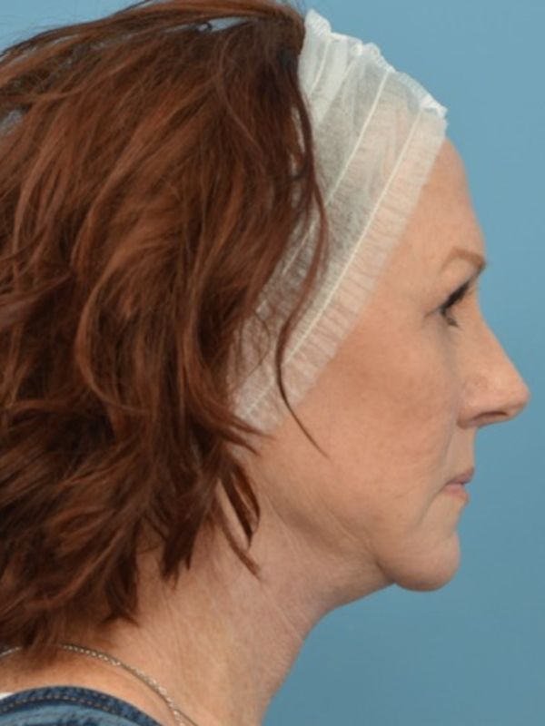 Neck Lift Before & After