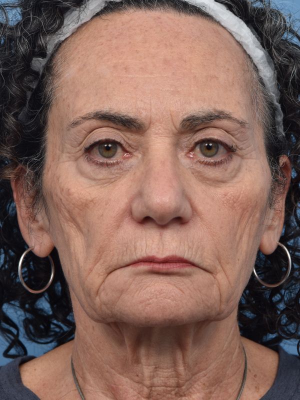Neck Lift Before & After