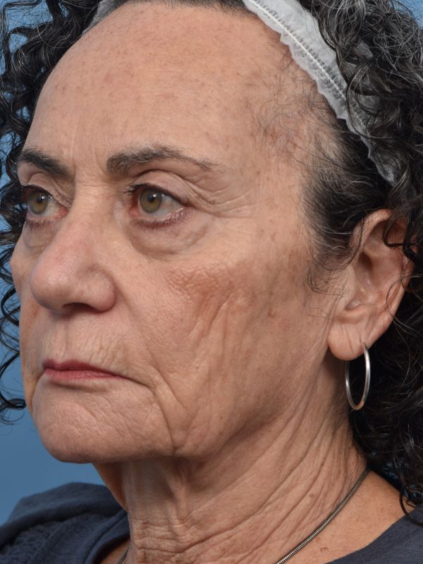 Neck Lift Before & After