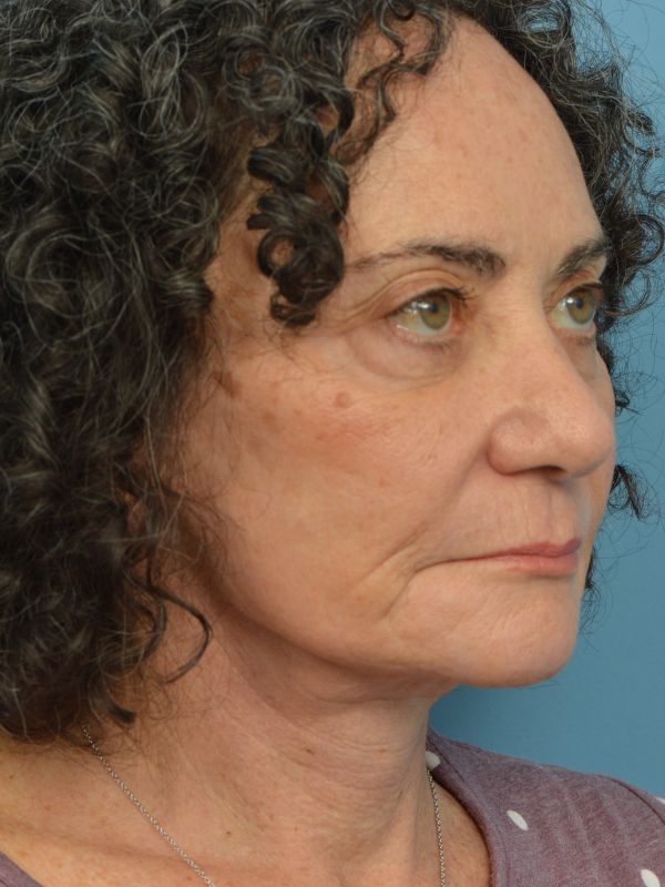 Neck Lift Before & After