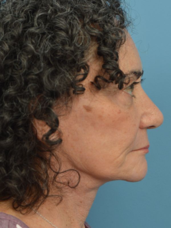 Neck Lift Before & After