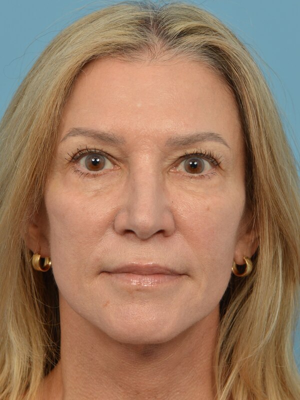 Neck Lift Before & After