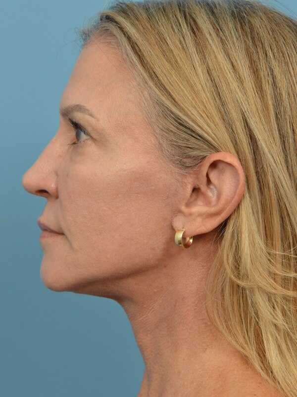Neck Lift Before & After