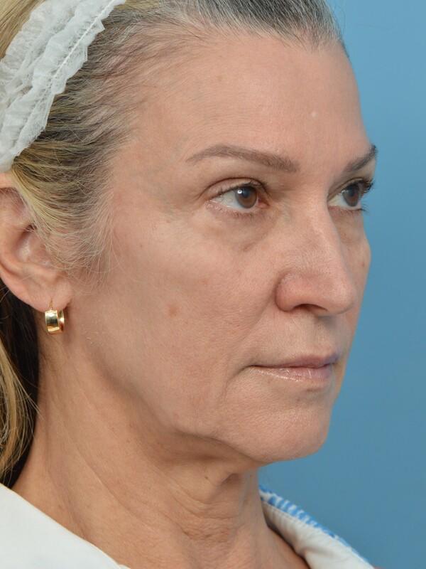 Neck Lift Before & After