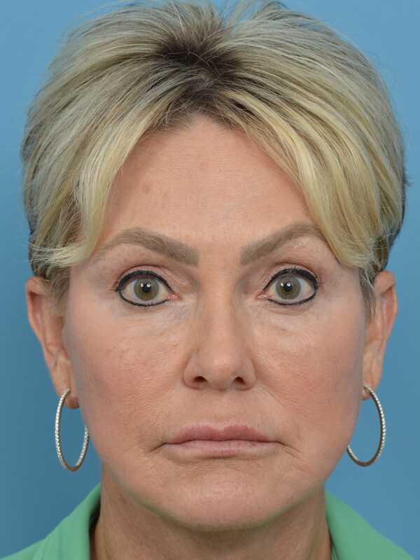 Neck Lift Before & After