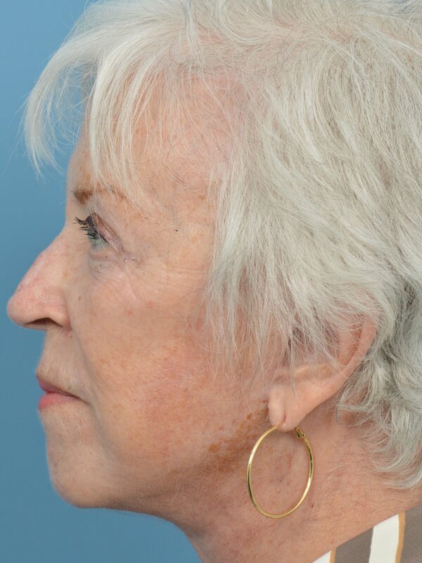Neck Lift Before & After