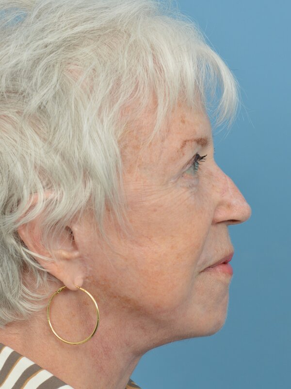 Neck Lift Before & After