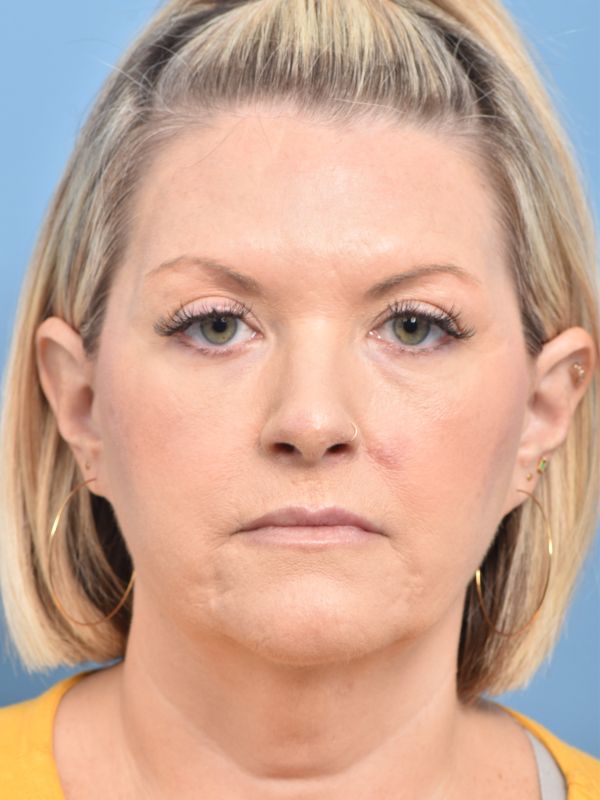 Neck Liposuction Before & After