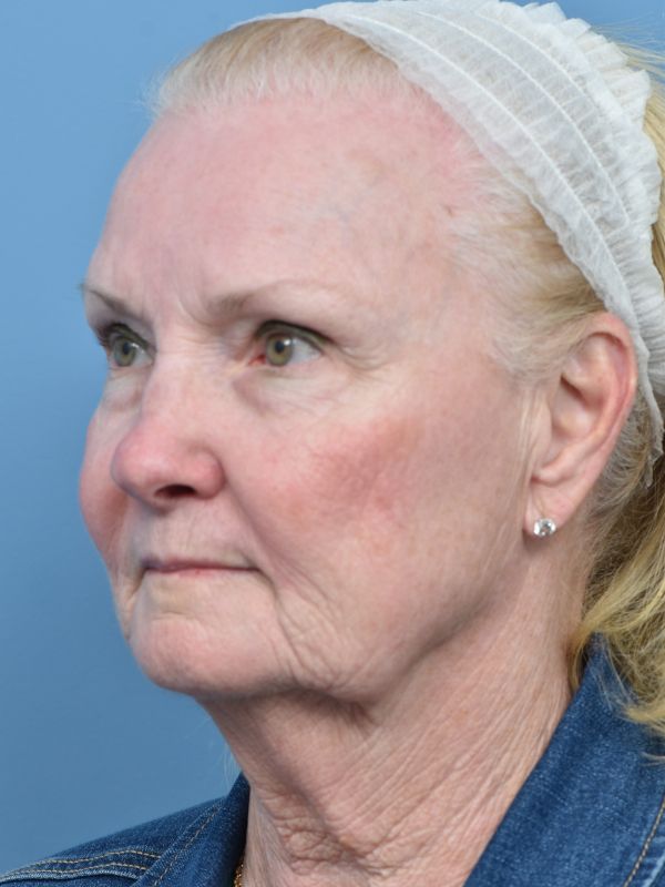 Neck Liposuction Before & After