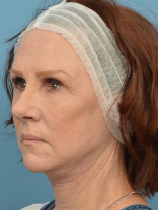 Neck Liposuction Before & After