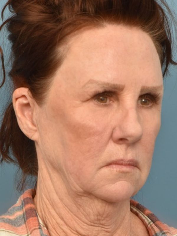 Neck Liposuction Before & After