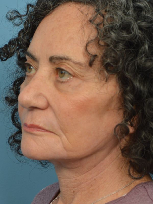 Neck Liposuction Before & After