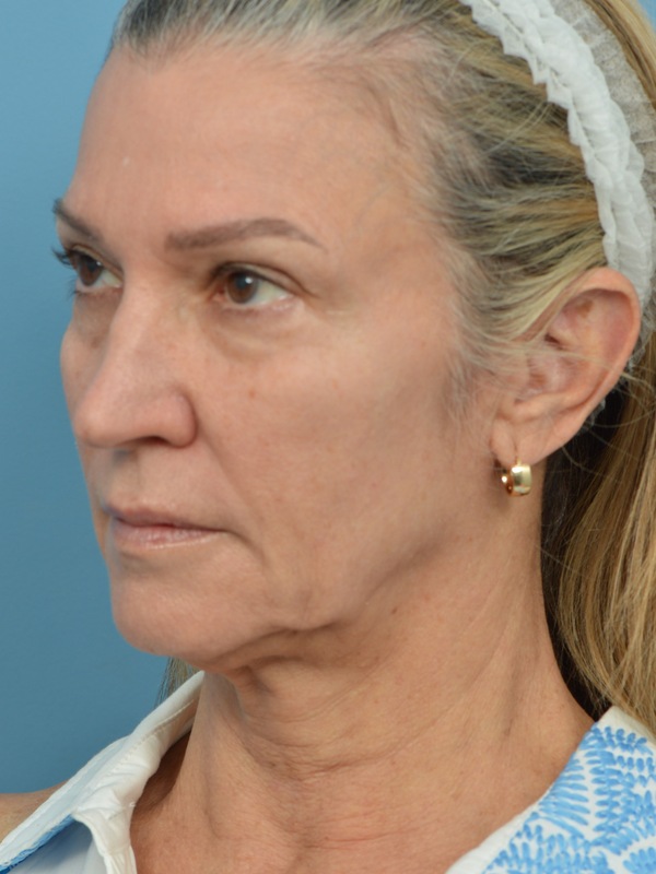 Neck Liposuction Before & After