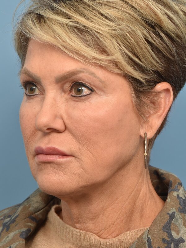 Neck Liposuction Before & After