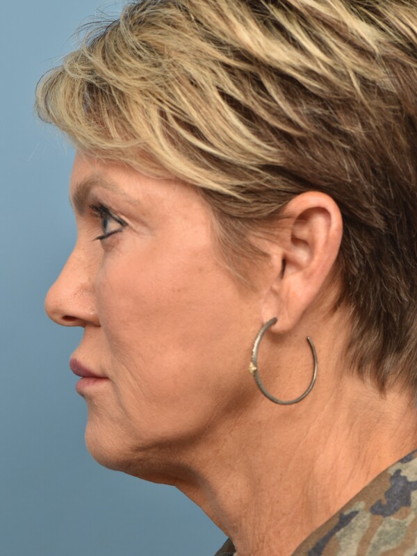 Neck Liposuction Before & After