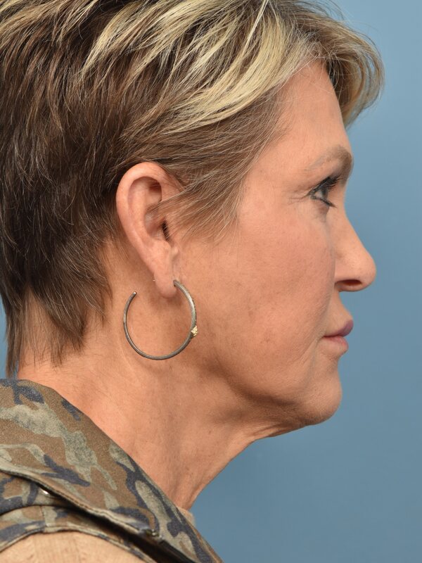 Neck Liposuction Before & After