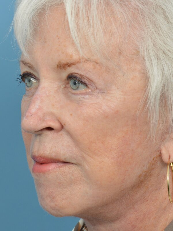 Neck Liposuction Before & After
