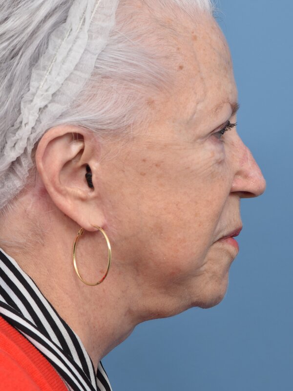 Neck Liposuction Before & After