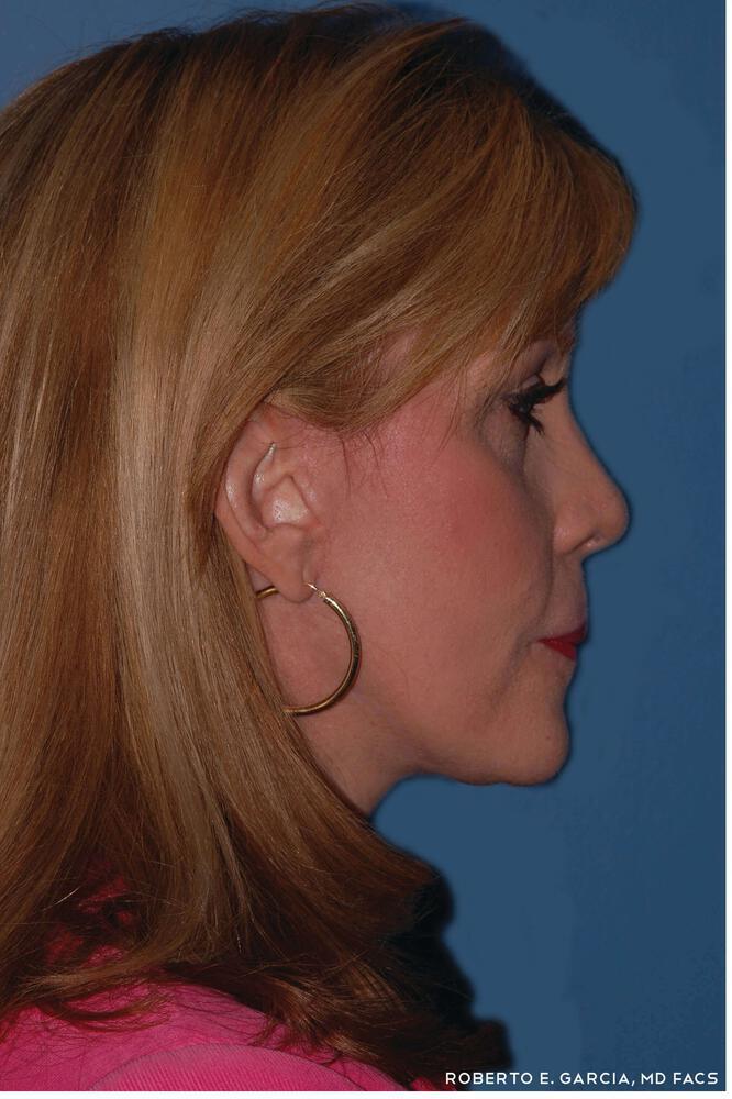 Rhinoplasty Before & After
