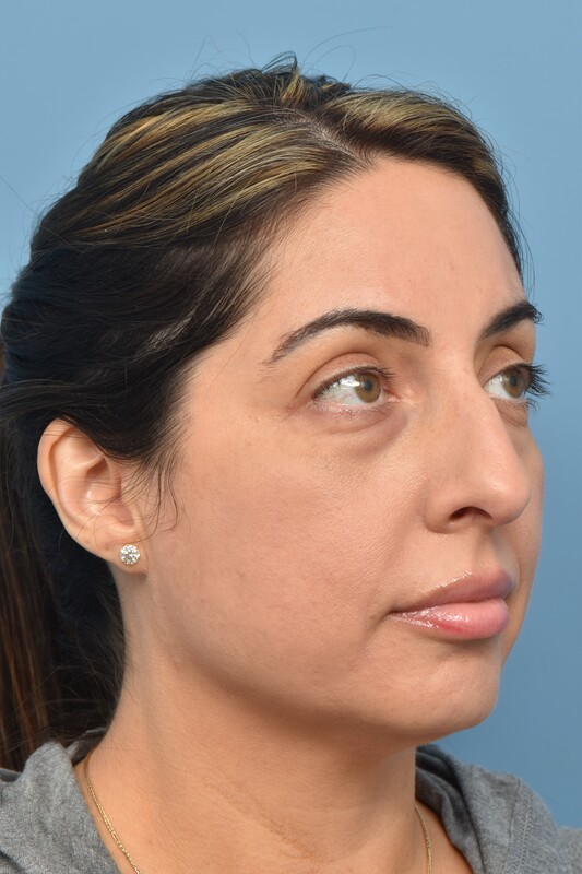 Rhinoplasty Before & After