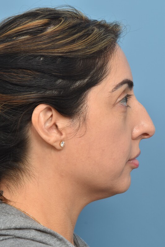 Rhinoplasty Before & After