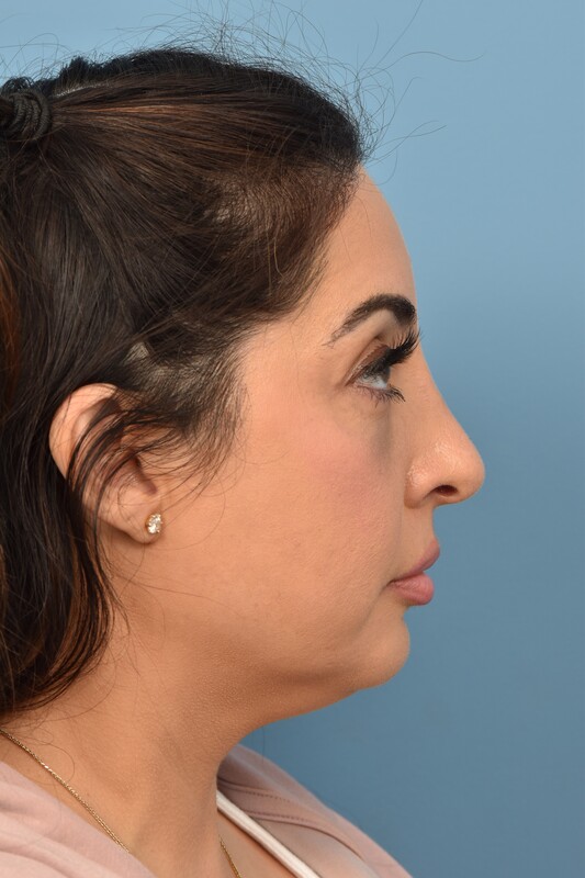 Rhinoplasty Before & After