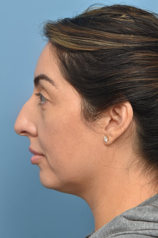 Rhinoplasty Before & After