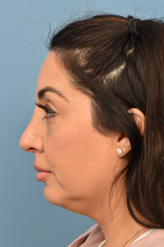 Rhinoplasty Before & After