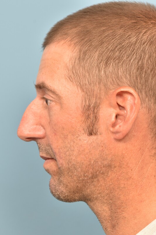 Rhinoplasty Before & After