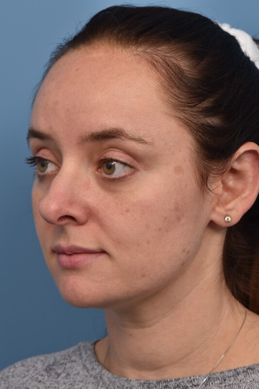 Rhinoplasty Before & After