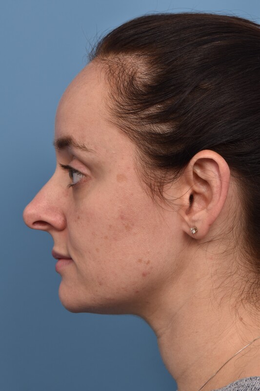 Rhinoplasty Before & After