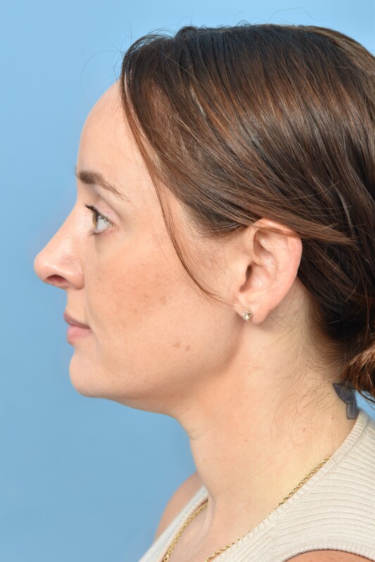 Rhinoplasty Before & After