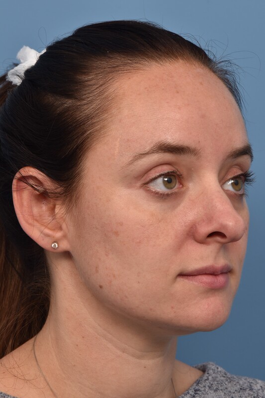 Rhinoplasty Before & After