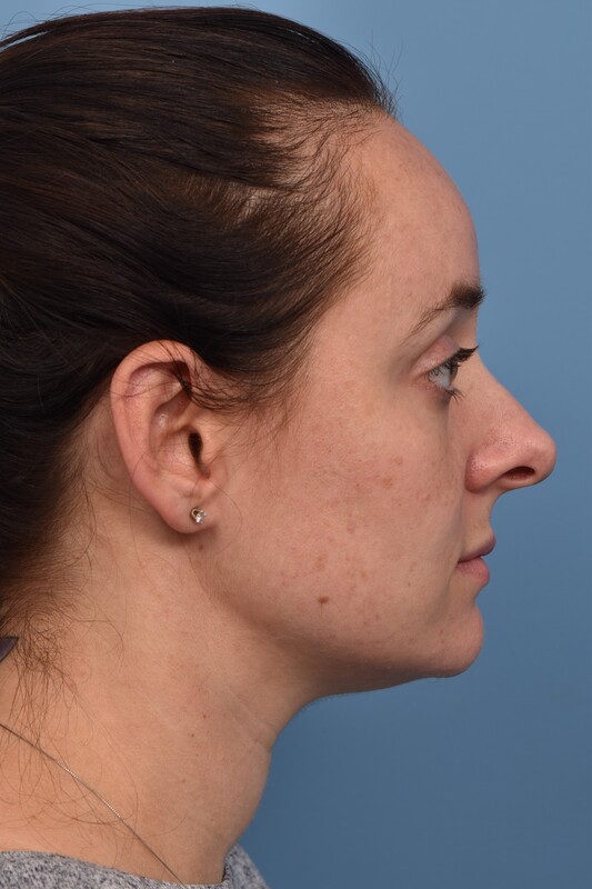 Rhinoplasty Before & After