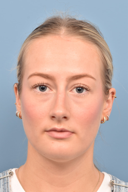 Rhinoplasty Before & After