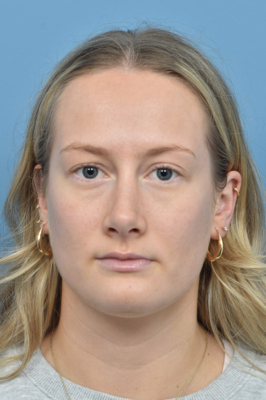 Rhinoplasty Before & After