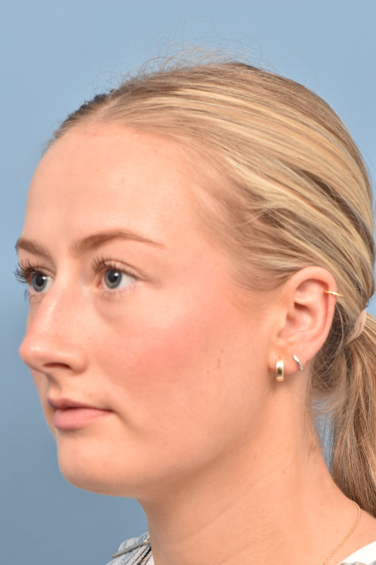 Rhinoplasty Before & After