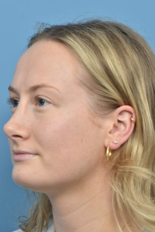 Rhinoplasty Before & After