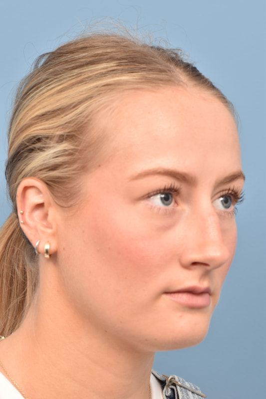 Rhinoplasty Before & After