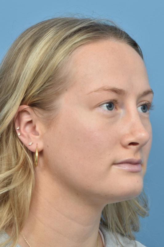 Rhinoplasty Before & After