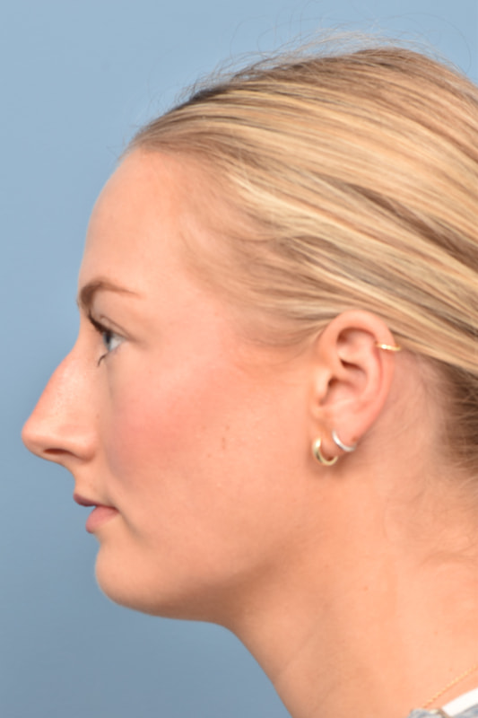 Rhinoplasty Before & After