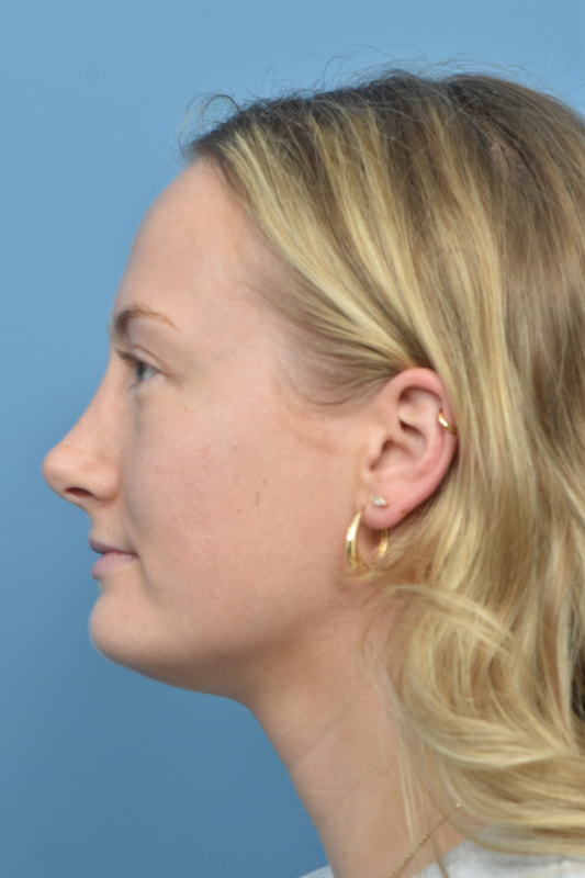 Rhinoplasty Before & After