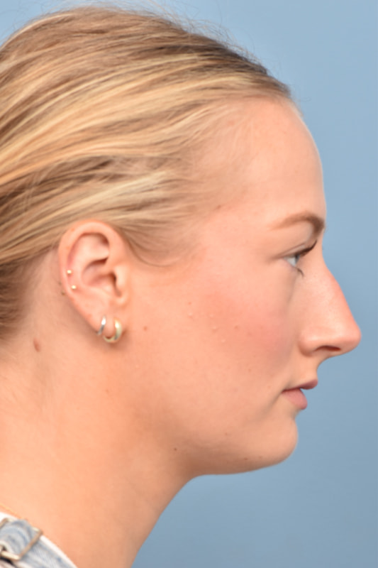 Rhinoplasty Before & After